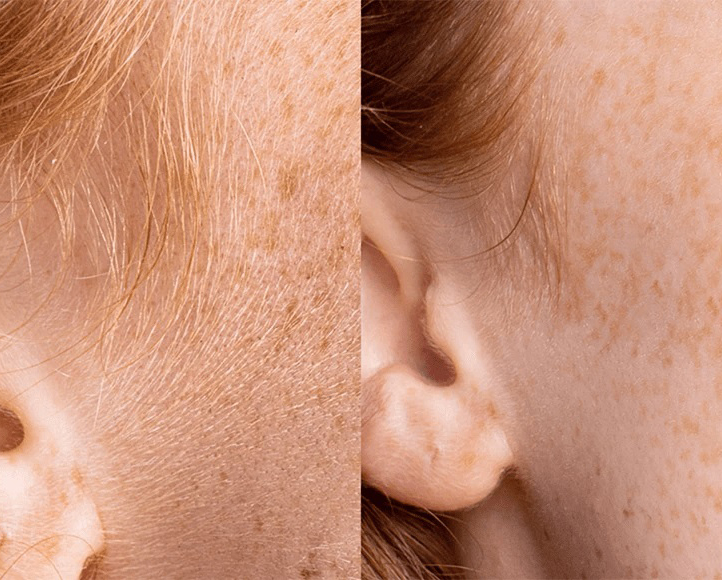 Triệt Lông Mặt Tại Sen Beauty